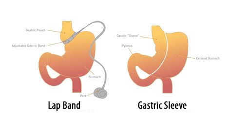 are lap band requirements for surgery